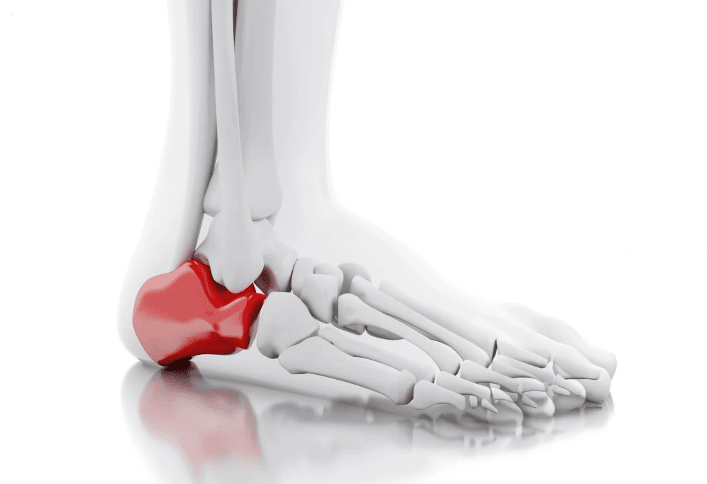 Heel Pain: Diagnosis and Management | AAFP